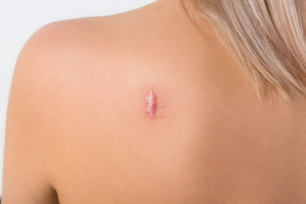 Exploring keloid scar removal options at EK Clinic Brackley